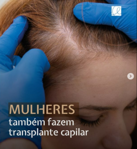 transplante capilar feminino em mulheres