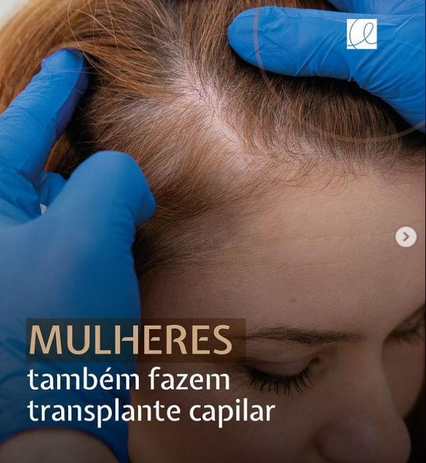 transplante capilar feminino em mulheres