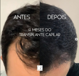 Os benefícios do transplante capilar para homens e mulheres e seu impacto na autoestima