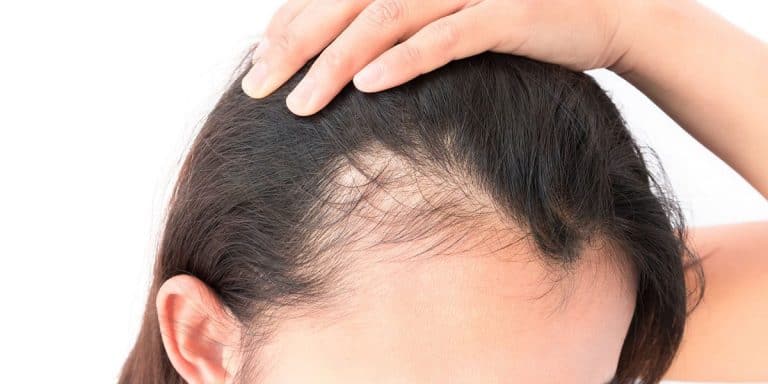Transplante Capilar Feminino — Mais do que estética, é sobre identidade e liberdade