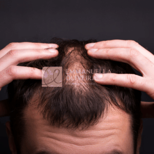 No Shave Hair Transplant: The Complete Guide to FUE No Shave