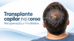 Transplante capilar na coroa: recuperação e resultados